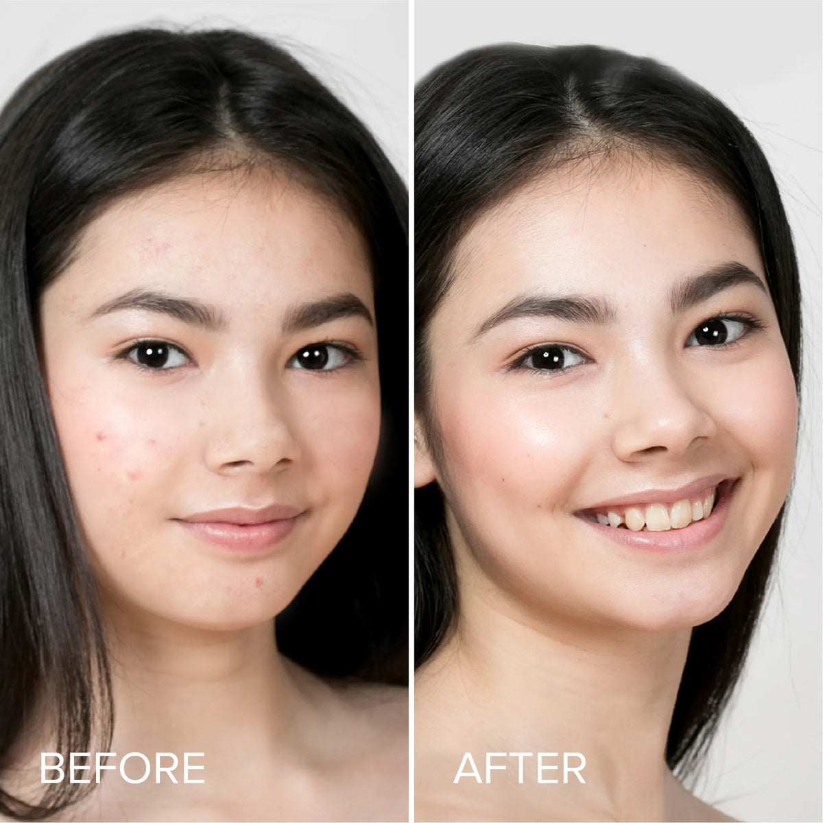 Hydrocolloid Pimple & Acne Patches